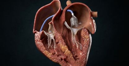 Onocor – Medical Device 3D Animation Video | Austin Visuals