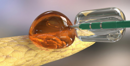 Accessor Medical Device 3D Animation