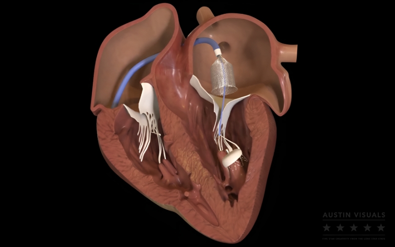 medical-device-implant-in-human-heart