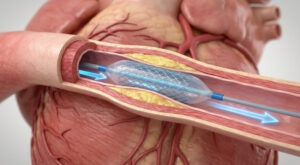 Animation Company vs Freelancer: What You Actually Need to Know Before Hiring 5 cardiovascular stent procedure visualized with d medical animation