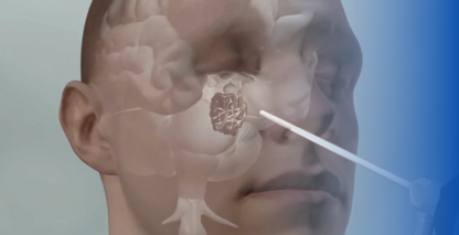 3D Brain Tumor Animation for Netflix’s ‘Pain Hustlers’ | Austin Visuals Medical Animation