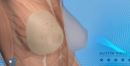 3D Medical Breast Implant Explainer Video