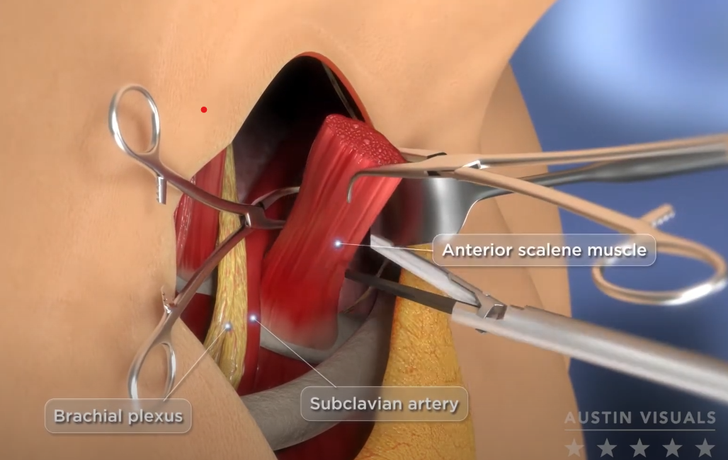 3D Surgical Explainer Medical Animation