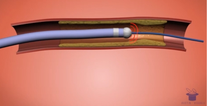 Angioplasty Device 3D Animation Video