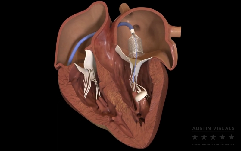 3D medical animation human heart internal view heart valves blood vessels medical device device placement Austin Visuals