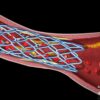 3D medical animation of a stent placement inside an artery depicting blood flow and detailed anatomy