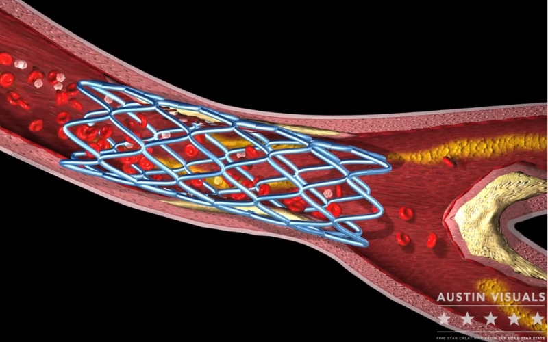 3D medical animation of a stent placement inside an artery depicting blood flow and detailed anatomy