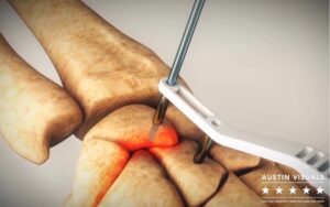 3D medical animation showcasing a surgical procedure involving bone fixation using advanced tools