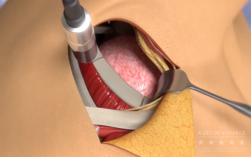 3D medical animation showing a surgical procedure with detailed visualization of muscles tissues and surgical tools