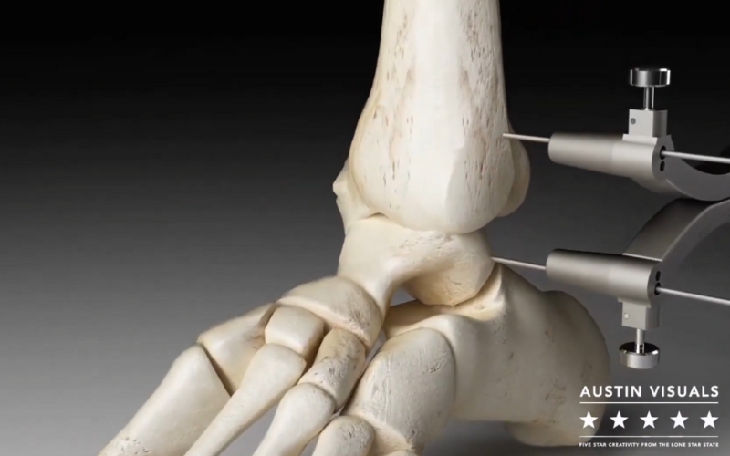 3D rendering of an orthopedic surgery simulation showing an ankle joint with medical instruments attached