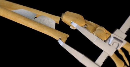 Hand Bone Repair Orthopedic 3D Animation