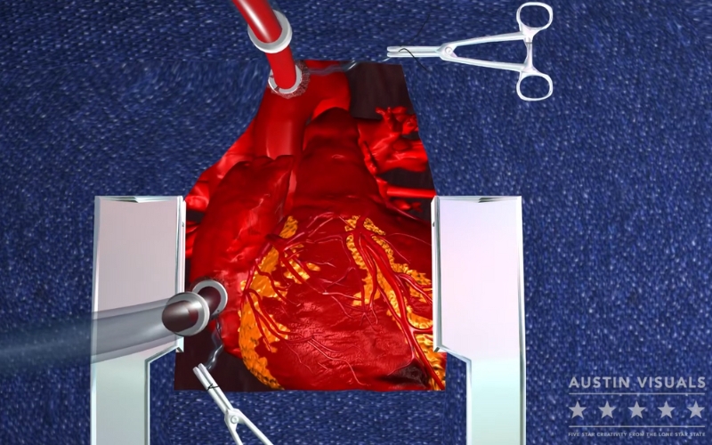 3d animation showcasing a detailed heart bypass surgery procedure featuring realistic surgical tools anatomy and an accurately rendered heart model by Austin Visuals