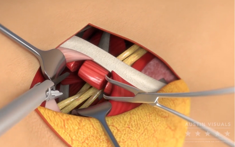 3d medical animation shoulder surgery surgical incision detailed tissue structure muscles and tendons surgical instruments in action medical visualization