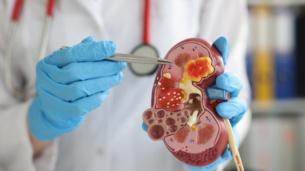 Navigating the Intricacies of Kidney Transplant Through 3D Animation