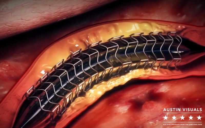 Close up 3D animation of a stent placement in an artery showcasing detailed anatomical accuracy and realistic rendering by Austin Visuals