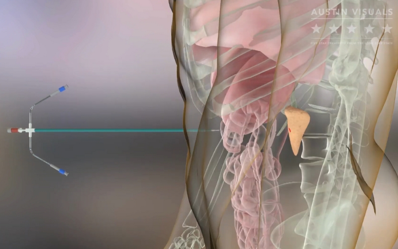 Custom Medical Device Animation for Accessor Medical