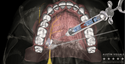 Dental Anesthesia 3D Animation