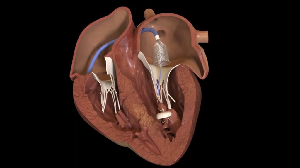 Medical D Animation for ONO Endovascular Retrieval Device