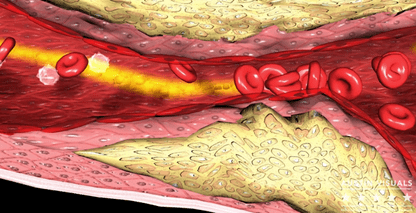 Myocardial Infarction Thrombosis