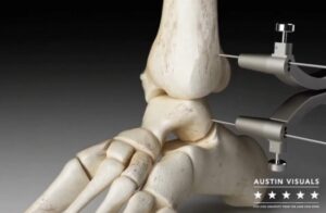 Orthopedic 3D Animation