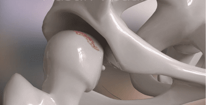 Hip Brace 3D Medical Animation – Excyabir | Austin Visuals
