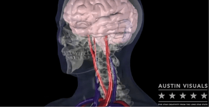 Stroke Visualization Video | 3D Medical Animation | Austin Visuals