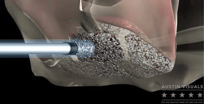 3D Medical Animation – Surgical Dental Procedure