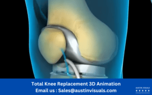 Total Knee Replacement 3D Animation | Client Orthopaedic Clinic Sydney