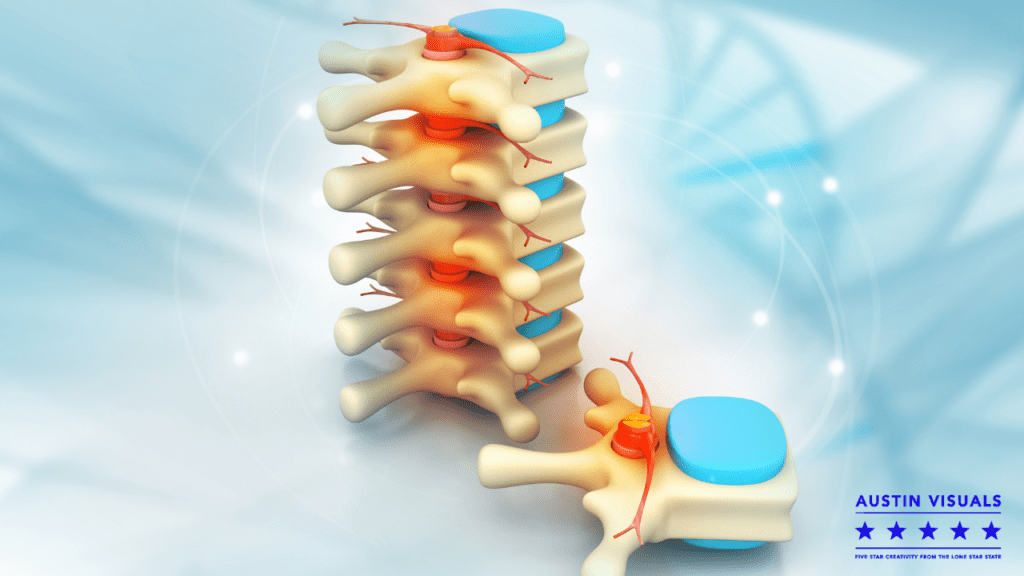 Medical 3D Animation For Spine Surgery