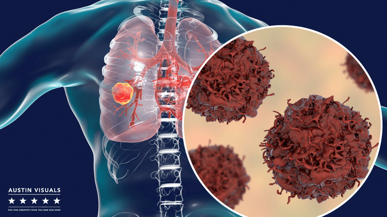Medical Illustration of the lungs showing the infected part of a virus in 3D