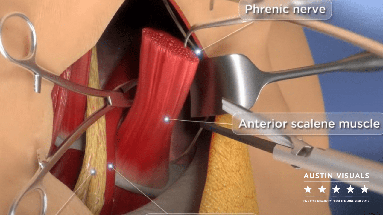 3D animation of an Anterior scalene muscle surgery when Hiring Professional Illustration Services