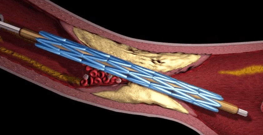 Heart Surgery 3D Medical Visualization | Angioplasty Stents