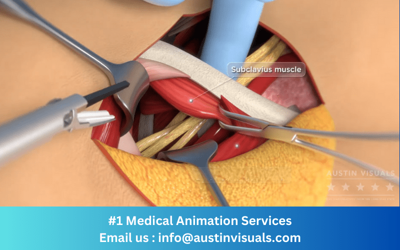 Screenshot of a 3D medical animation video showing a shoulder surgery produced by Austin Visuals. The animation displays a 3D model of a shoulder joint and the surgical procedure being performed on it
