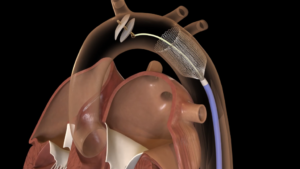 Onocor – Medical Device 3D Animation | Austin Visuals