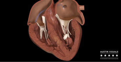 Onocor – Medical Device 3D Animation | Austin Visuals