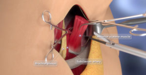 anterior scalene muscle repair procedure 3d animation