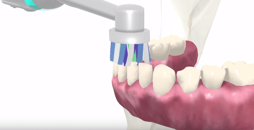 Tooth Replacement Implant Procedure 3D Animation