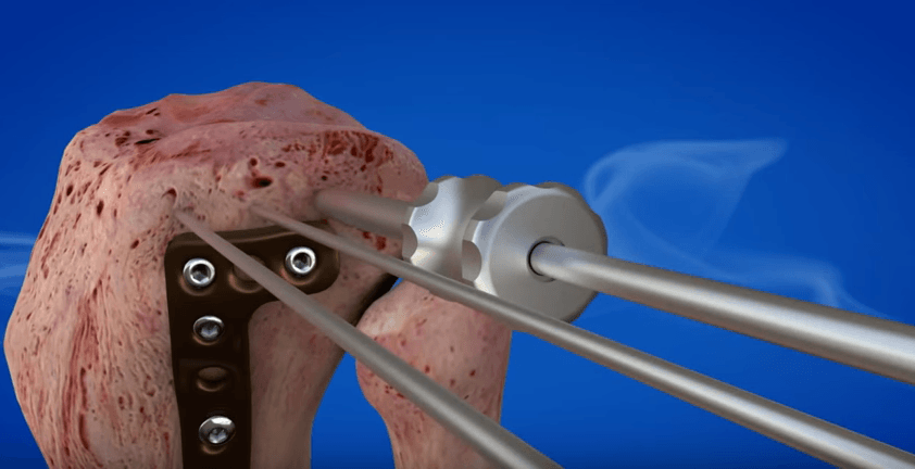 Total Knee Replacement Surgical Procedure 3D Animation